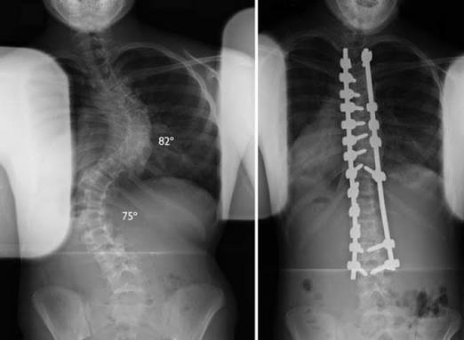 Gentle Scoliosis Treatment For Families In Georgetown, TX